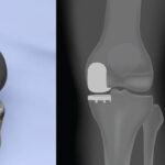 partia-knee-replacement