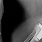 revision-joint-replacement-surgery