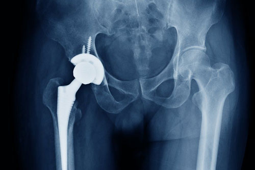 total-hips-replacement