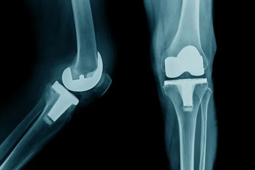 total-knee-replacement